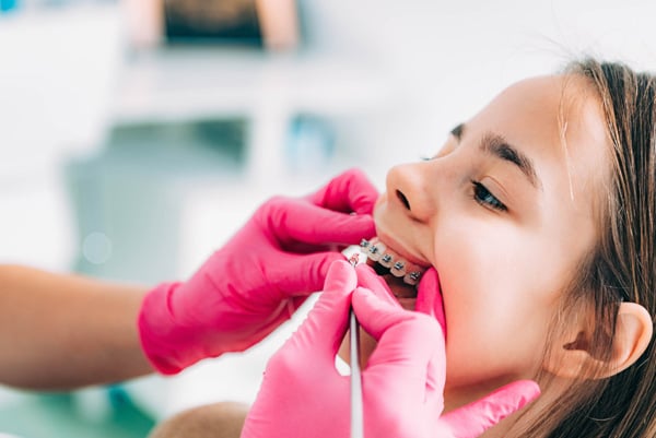 Niềng răng trẻ em bằng mắc cài cố định