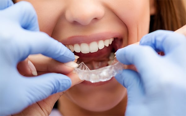 Niềng răng trẻ em bằng khay niềng trong suốt Invisalign