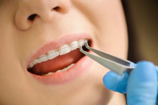 Phương pháp niềng răng mắc cài sứ