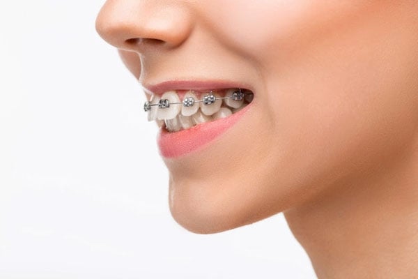 Niềng răng hàm trên có thật sự hiệu quả?