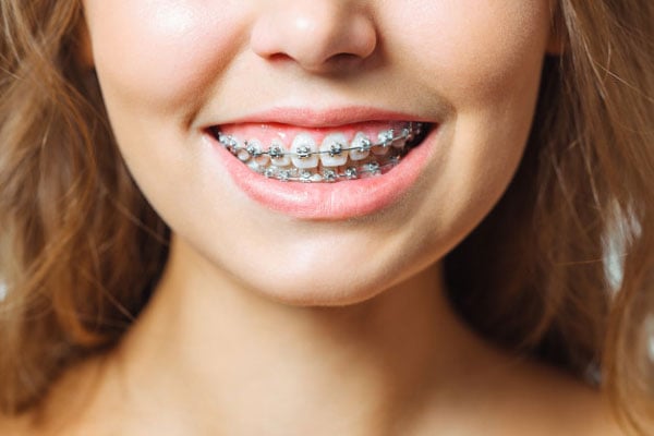 Chỉ niềng răng hàm trên có thực sự hiệu quả không?