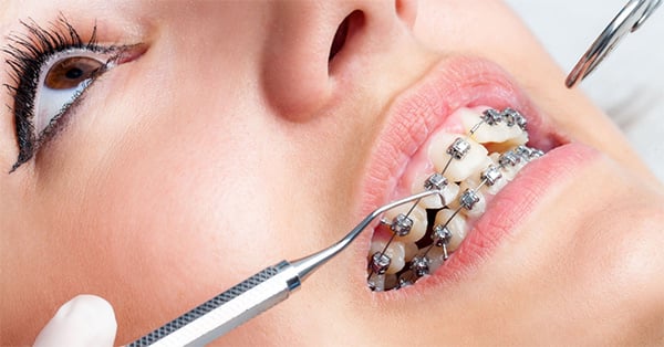 Phương pháp niềng răng cho người lớn