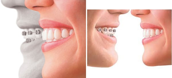 Thời gian niềng răng cho người lớn dài hơn trẻ em