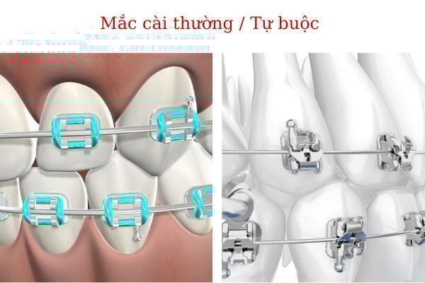 Niềng răng mắc cài kim loại