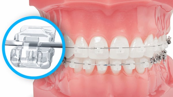 Niềng răng mắc cài sứ