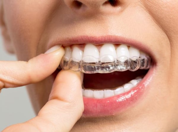 Niềng răng không mắc cài Invisalign