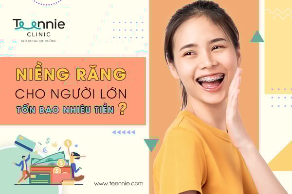 Chi phí niềng răng cho người lớn