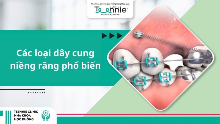 Các loại dây cung niềng răng phổ biến