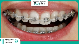 Niềng răng mắc cài kim loại truyền thống phù hợp cho những tình trạng răng mọc lệch lạc nghiêm trọng