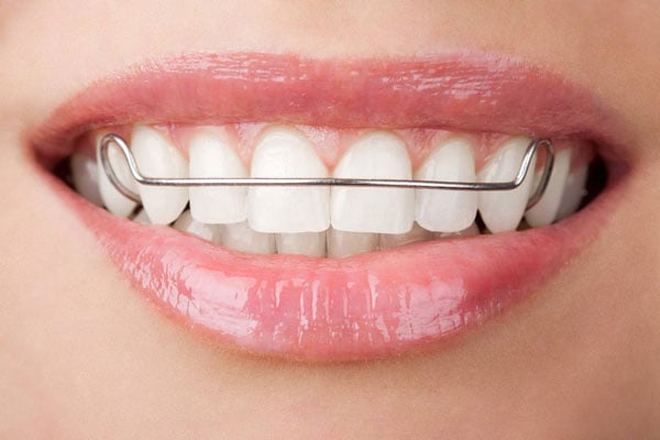 Hàm duy trì sau khi niềng răng là gì?