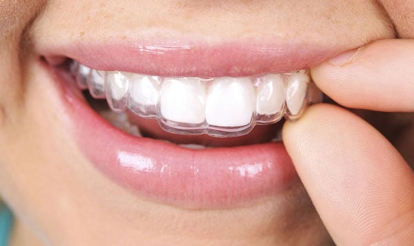 Phương pháp hàm duy trì tháo lắp bằng khay nhựa trong suốt