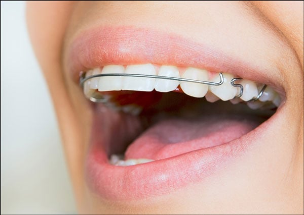 Hàm duy trì sau khi niềng răng đeo trong bao lâu?