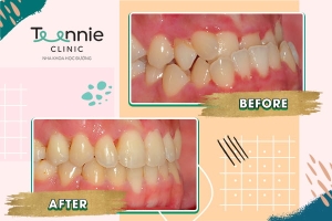 Hình ảnh trước và sau khi niềng răng