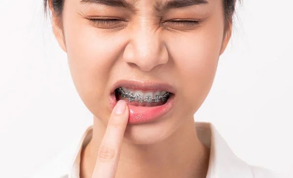 Người niềng răng ăn gì?