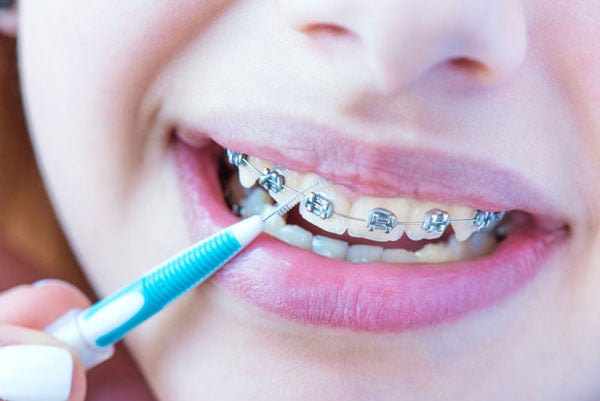 Kinh nghiệm khác cho người niềng răng ăn gì