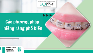 Các phương pháp niềng răng phổ biến