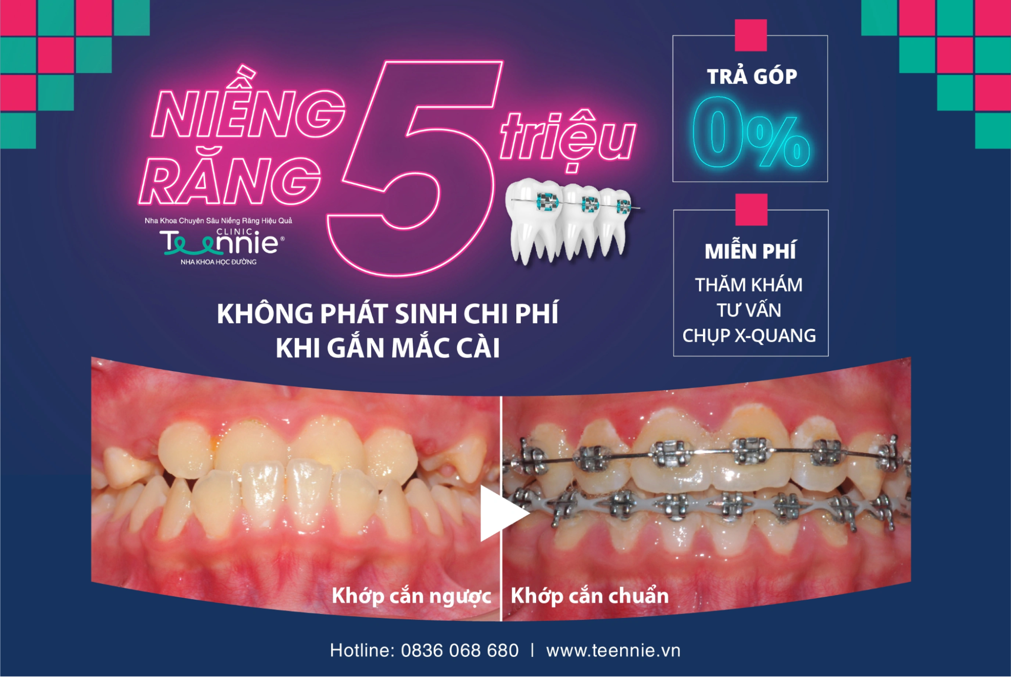 Chính sách trả góp 5 triệu tại Nha khoa Teennie