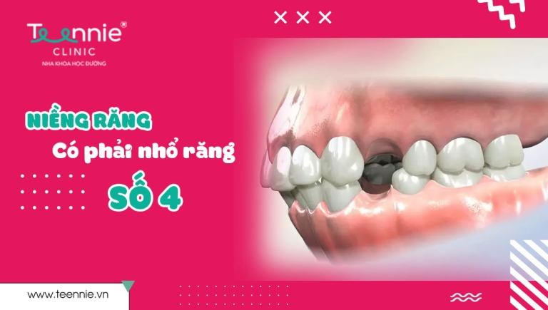 Có nên nhổ răng số 4 để niềng không?