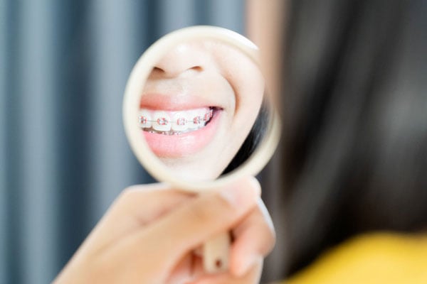 Niềng răng có làm yếu răng đi ?