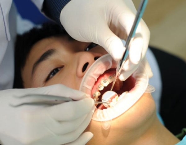 Nguyên nhân dẫn đến niềng răng có làm yếu răng đi 
