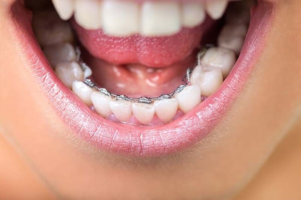 Phương pháp niềng răng mắc cài mặt trong là gì?