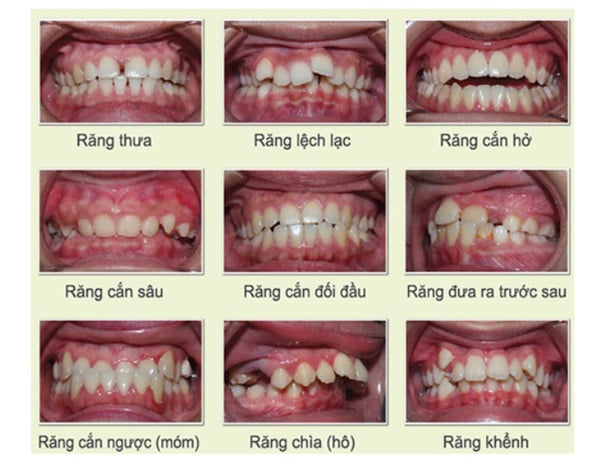 Sai khớp răng