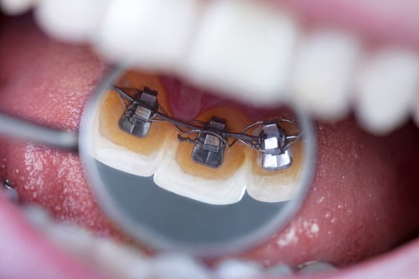 Quá trình niềng răng mắc cài mặt trong chi tiết