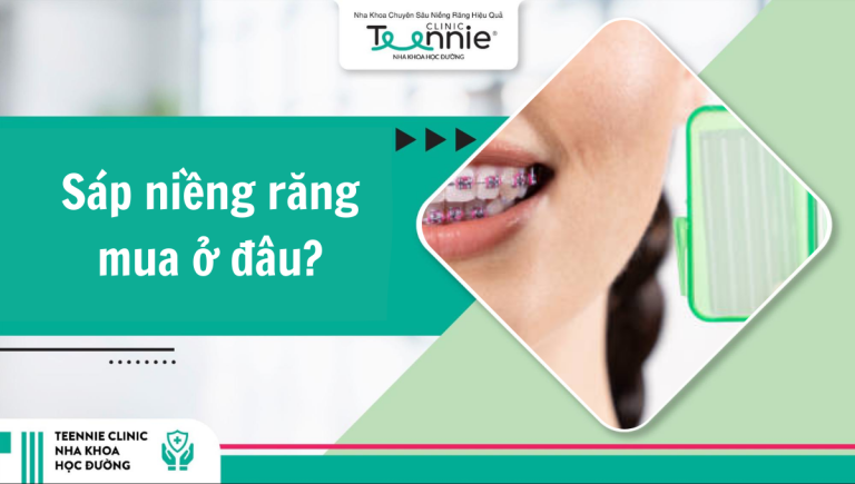 Sáp niềng răng mua ở đâu để đảm bảo chất lượng?
