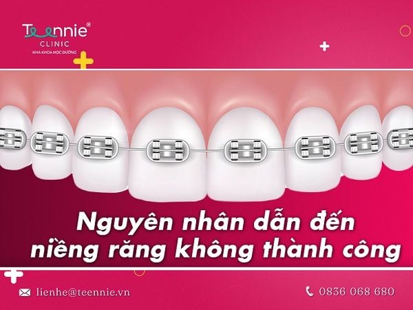 Nguyên nhân dẫn đến niềng răng không thành công