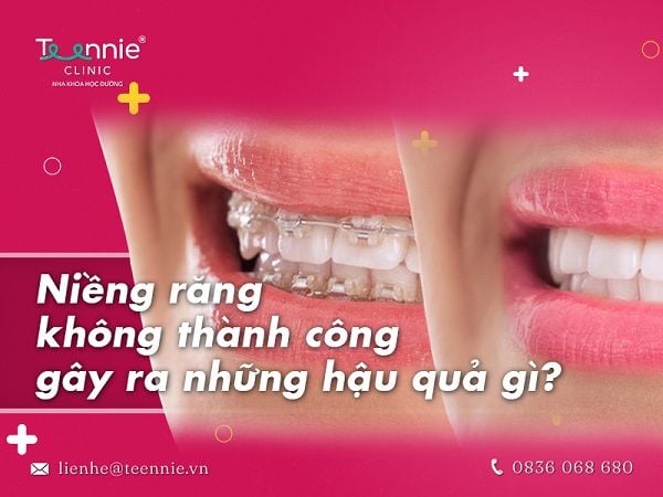 Hậu quả của niềng răng không thành công