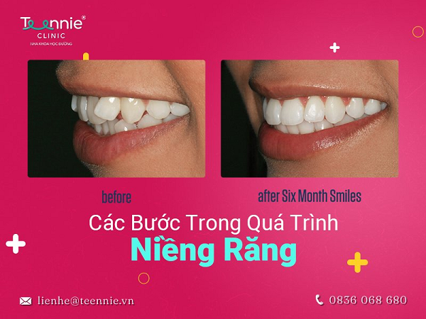 Quá trình niềng răng