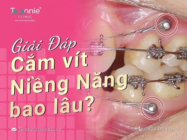 Cắm vít niềng răng bao lâu thì tháo?