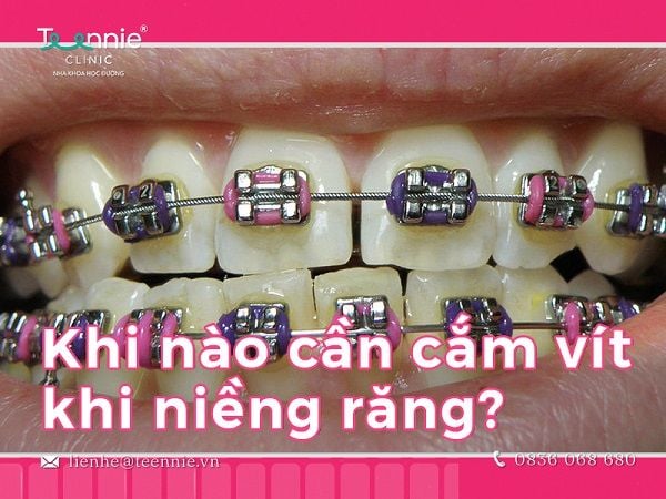 Những trường hợp răng móm, hô, thưa, lệch lạc,… thường được cắm vít niềng răng