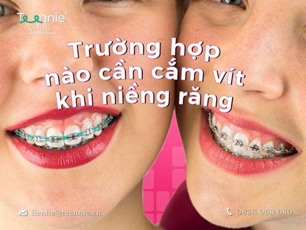 Cắm vít niềng răng bao lâu thì tháo phụ thuộc nhiều vào mức độ nghiêm trọng của tình trạng răng