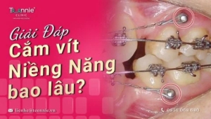 Cắm vít niềng răng bao lâu thì tháo?