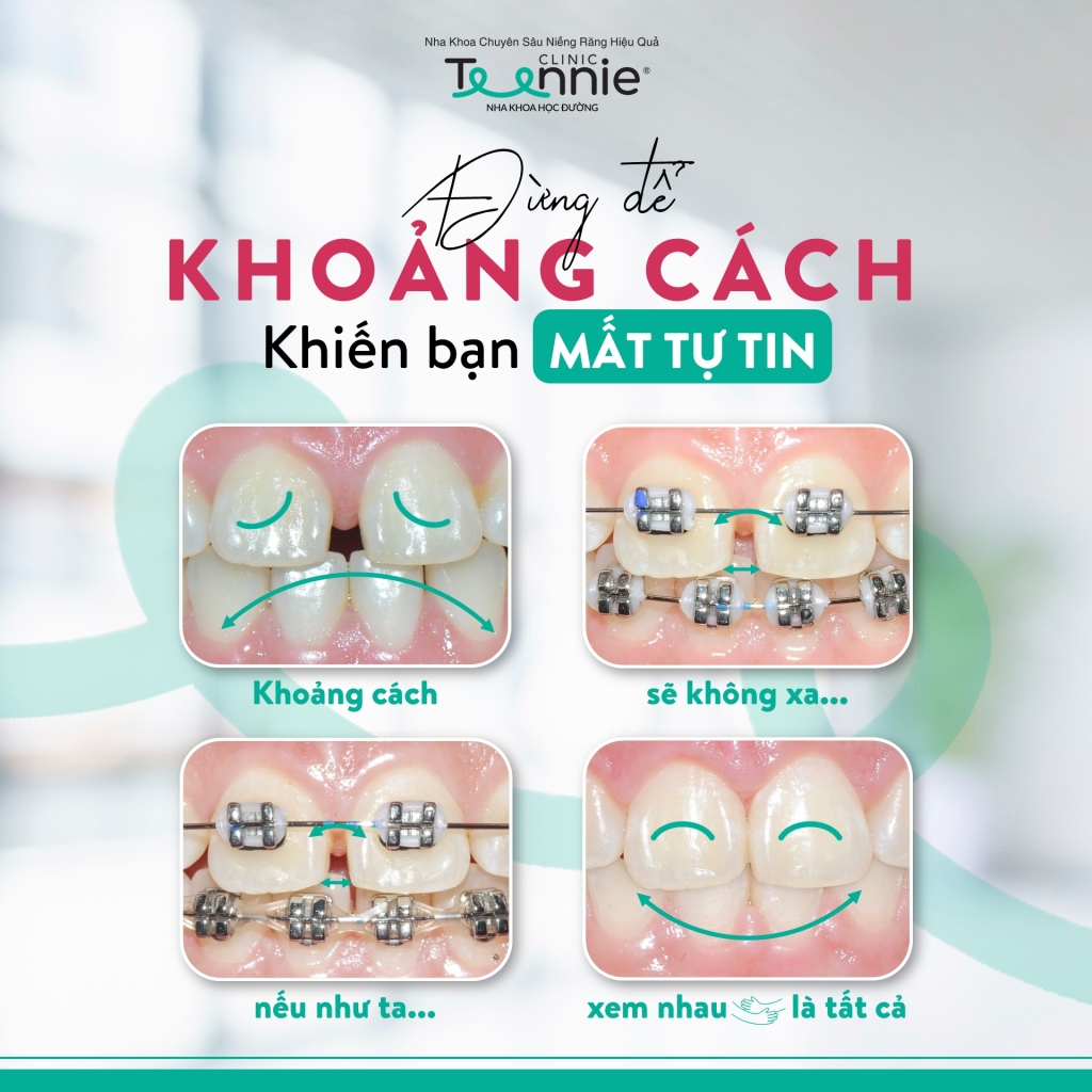 Niềng răng đem lại nụ cười xinh