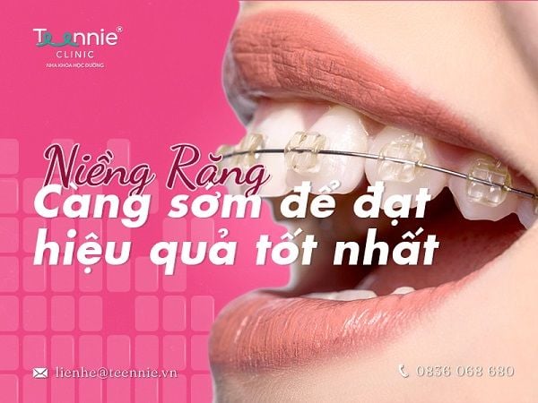 11 - 16 tuổi là thời điểm lý tưởng nhất để niềng răng