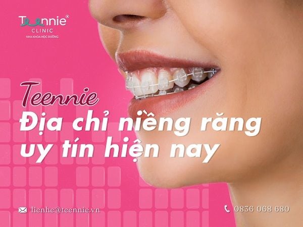 Nha khoa học đường Teennie - địa chỉ niềng răng uy tín hiện nay