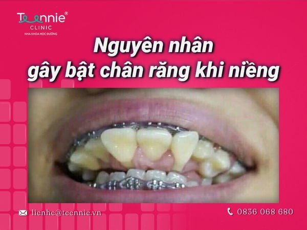 Bật chân răng khi niềng nguyên nhân do đâu?