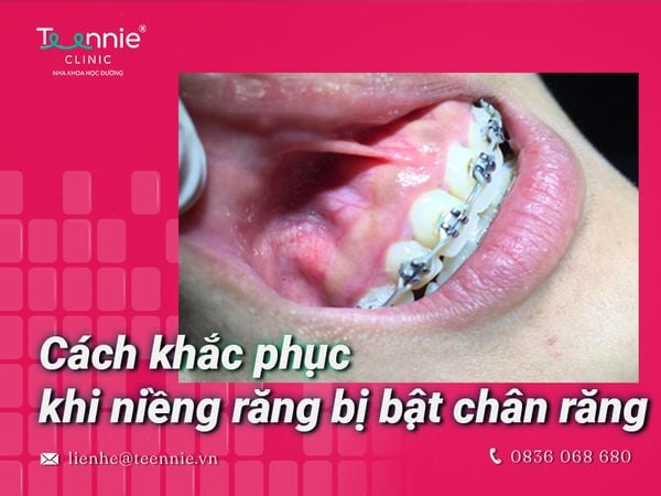 Cách khắc phục khi niềng răng bị bật chân răng