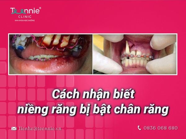 Dấu hiệu nhận biết bị bật chân răng khi niềng