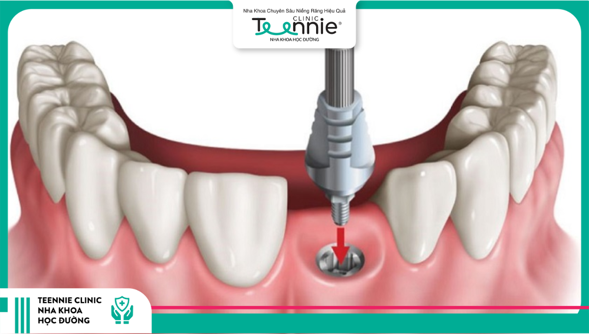 Cấy ghép Implant là phương pháp thay thế chân răng bị mất bằng một trụ titanium được đặt vào xương hàm