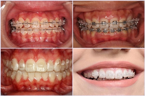 Lí do bạn nên niềng răng càng sớm càng tốt
