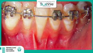 Niềng răng có bị tụt lợi không