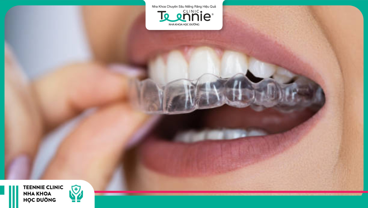 Niềng răng trong suốt Invisalign là giải pháp hiện đại được nhiều người lựa chọn