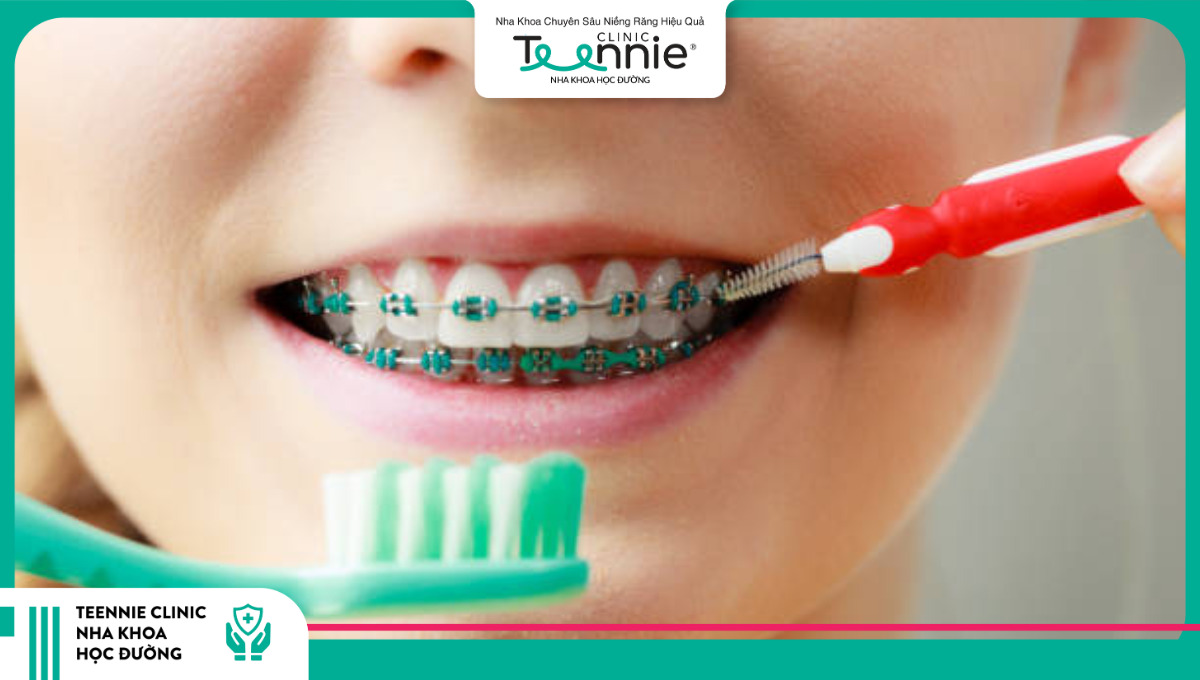 Chăm sóc răng miệng là yếu tố quan trọng giúp rút ngắn thời gian niềng răng