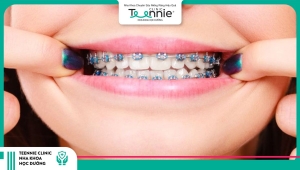 19 tuổi niềng răng bao lâu thì có thể tháo niềng?