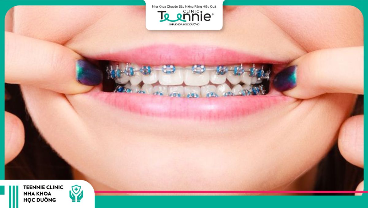 19 tuổi niềng răng bao lâu thì có thể tháo niềng?