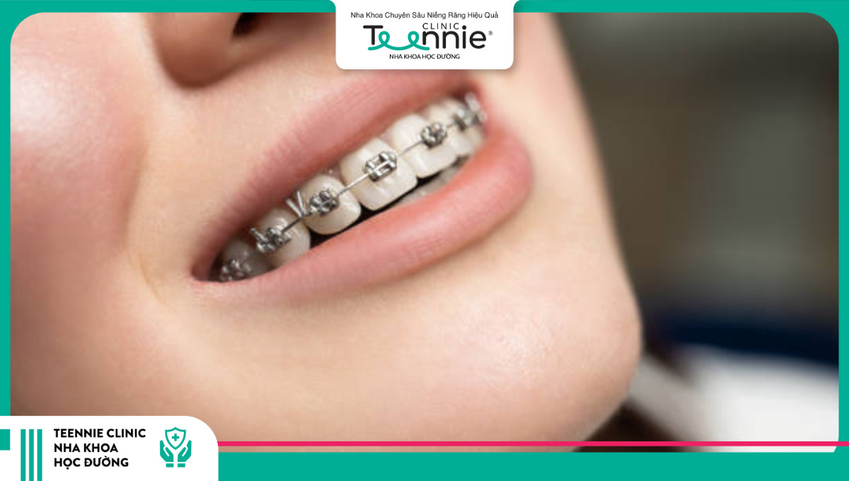 19 tuổi niềng răng bao lâu tuỳ thuộc vào từng trường hợp răng miệng cụ thể 