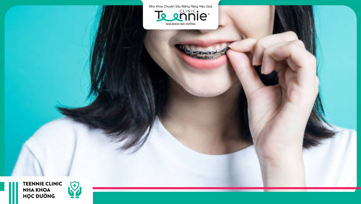 19 tuổi niềng răng bao lâu thì có thể tháo được?